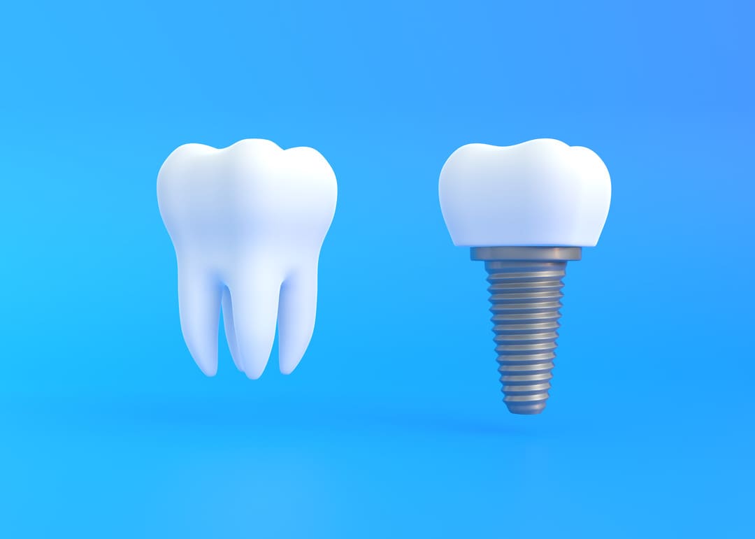 implants